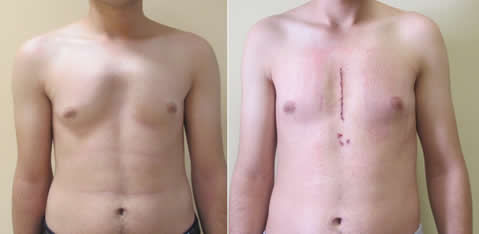The pre- and post-operative images of a patient, whose deformity was corrected with the Ravitch procedure in Dr.Pectus Clinic Turkey