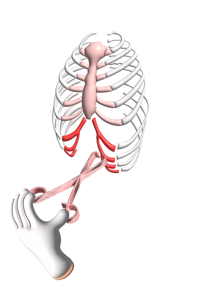 Rib Flare Removal - Cartilage Removal - Flared Rib Treatment