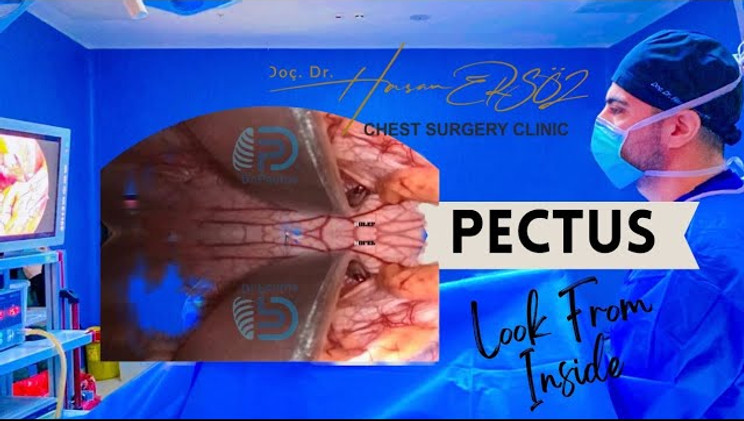 pectus excavatum treatments in turkey - Nuss. Procedure