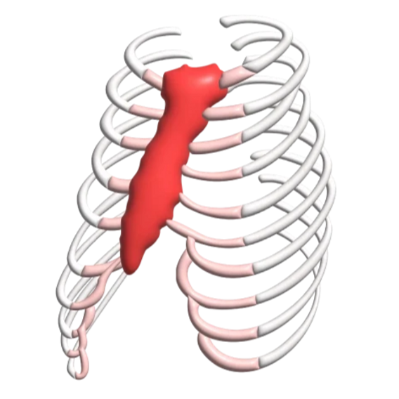 Pigeon Chest (Pectus Carinatum) ⎮ Dr.Pectus Turkey