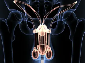 Varicocele Embolization: A Simple Treatment for a Common Cause of Male Infertility