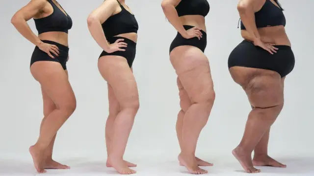 O que você precisa saber sobre Lipedema e seus sintomas principais