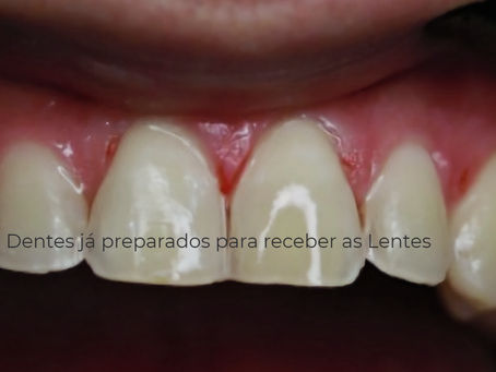 Preciso desgastar meus dentes para a confecção de Lentes Dentais?