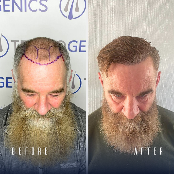 Hair Trasnplant in Greece