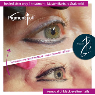 usunięte brwi , Microblading , usuń makijaż permanentny #usuwamymakijaze #pigmentremover #