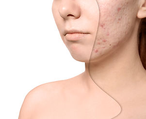 Young woman before and after acne treatment on white background. Skin care concept.jpg