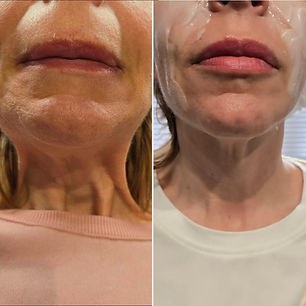 botox neck.jpg