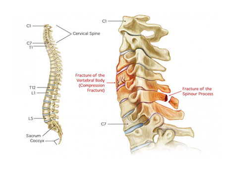 🧠 Fracturas cervicales y salud vertebral: ¿puede la quiropráctica ayudar?