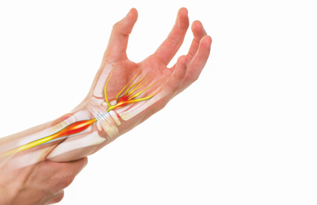 ¿Realmente Tengo “Carpal Tunnel”?