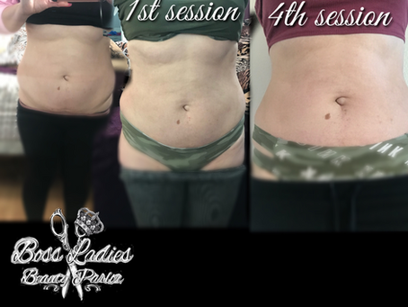 Lipo cavitation
What is Ultrasound Cavitation?