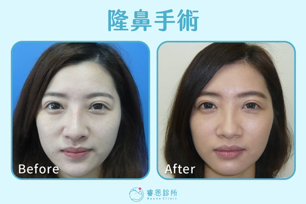 隆鼻手術_BA_2.jpg