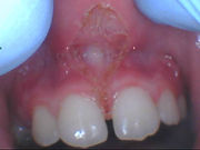 Lip Tie example photo