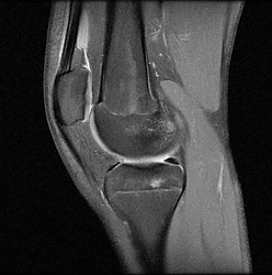 Οστικό οίδημα και Φυσιοθεραπεία