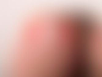 Ingrown Toenails: When to See a Podiatrist vs. Home Care