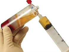 PRP platelet rich plasma injections