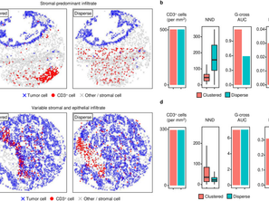 [Journal clubs] Jul 17,2025 [Tumor-immune partitioning and clustering algorithm for identifying tumor-immune cell spatial interaction signatures within the tumor microenvironment]