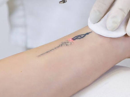 6 Most Frequently Asked Questions from Tattoo Removal Patients