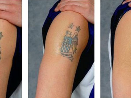 What Does Tattoo Removal Do To Your Skin?