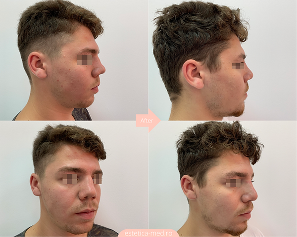 rinoplastie deviatie sept caz 4 dreapta