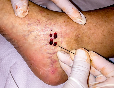 I am bleeding the ankle with a hypodermic needle, treating an acute gout attack in the ankle.