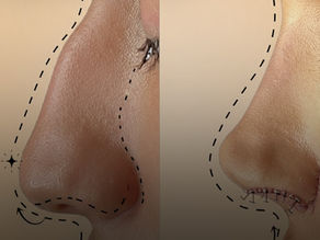 Best Rhinoplasty Surgeon In Dubai