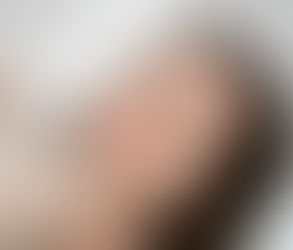 Rejuran Injections in Islamabad – Youthful Skin Naturally