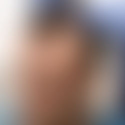 Which Hair Transplant is Best in Pakistan?