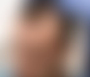 Which Hair Transplant is Best in Pakistan?
