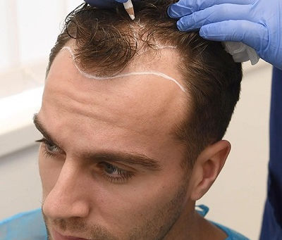 Which Hair Transplant is Best in Pakistan?