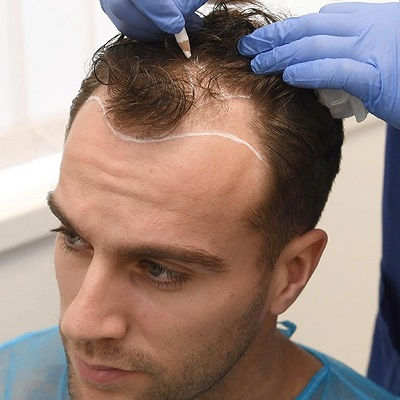 Which Hair Transplant is Best in Pakistan?