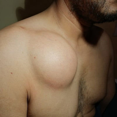 Lipoma Treatment in Dubai At Glamorous Clinic AE