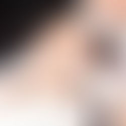 What is 5000 Hair Grafts?