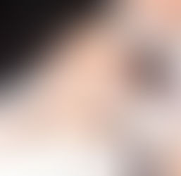 What is 5000 Hair Grafts?
