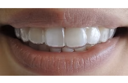 　マウスピース装着後　