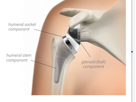 Understanding Reverse Shoulder Replacement Surgery: Benefits and Recovery