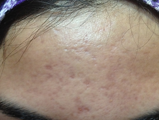 Acne After