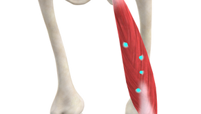 TRIGGER POINT OF THE WEEK – BICEPS FEMORIS