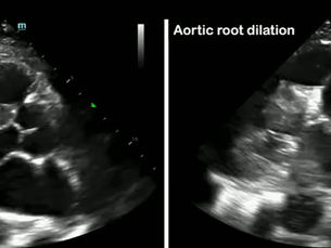 aortic root dilation in acute type A aortic dissection