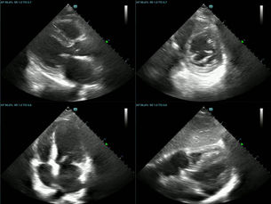 regional wall motion abnormalities