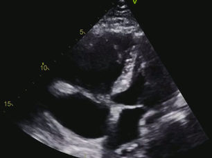 right ventricular dilation