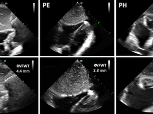 right ventricular free wall thickness
