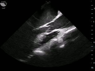 transesophageal echocardiography