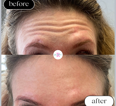 Botox Results in 2 weeks 🔥 Smooth or those fine lines and wrinkles with the magic of Neur