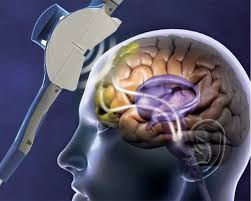 Excitatory rTMS on Pre-symptomatic High-risk AD Individuals to Delay Cognitive Decline