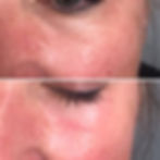 Skin booster (Jalupro)