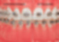 brackets-autoligables-o-convencionales.j