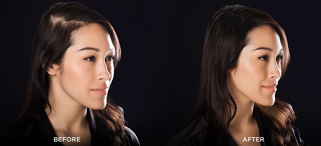 Is Hair Loss Genetic