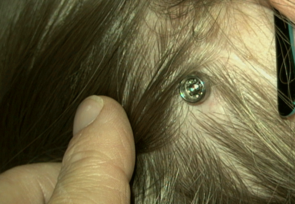 baha-implant-in-situ.gif