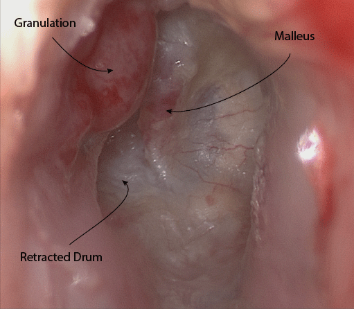 granulations-and-retraction-annotated.gi