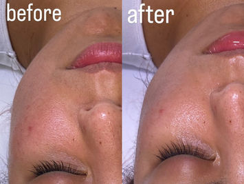Notice the significant improvement in client's crows feet and pores. 